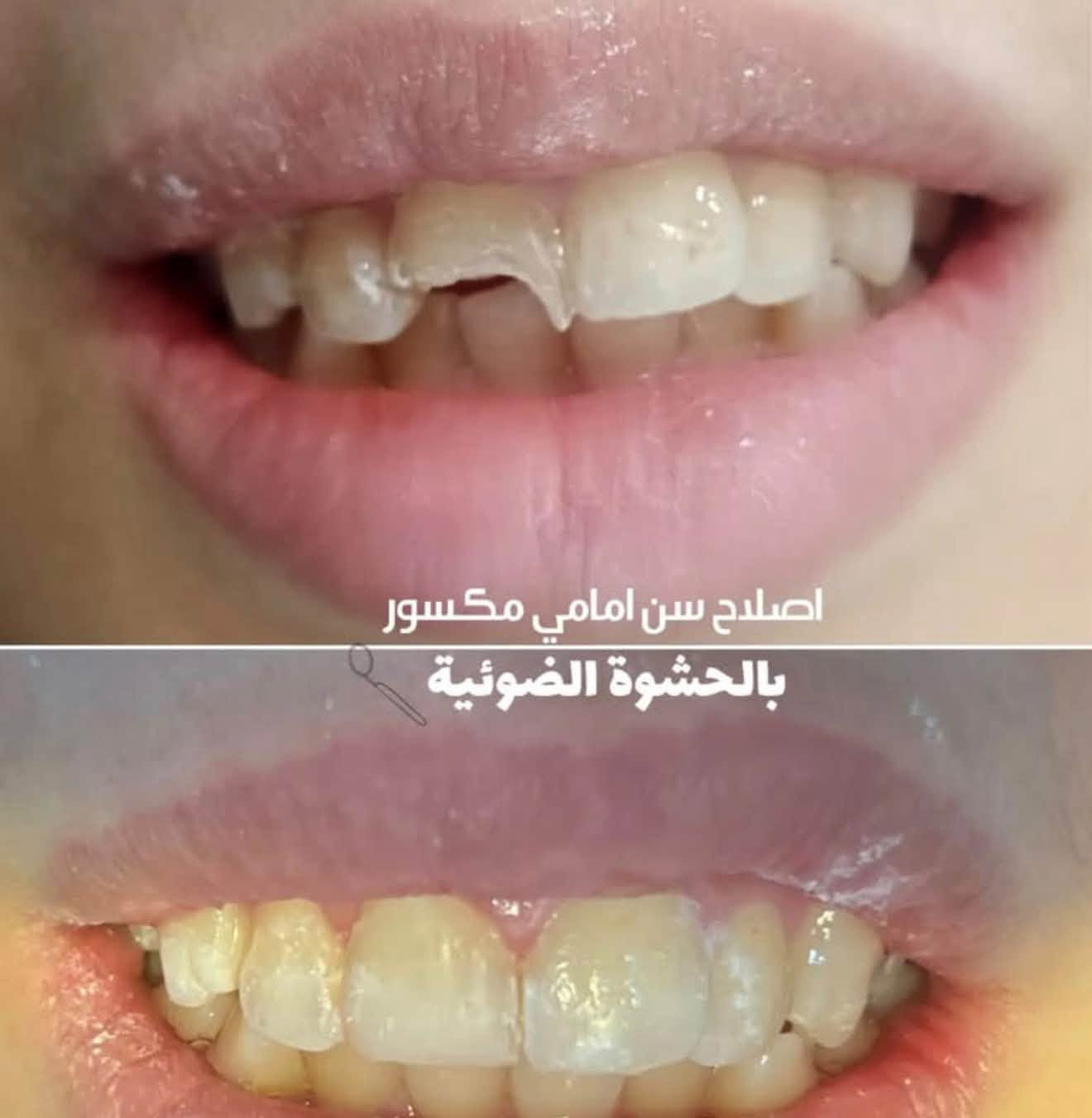 مجانا • عيادات المعقل • علاج تسوس