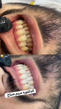 العلاج مجاني  السلام عليكم الي عنده مشكله باسنانه ويحتاج علاج او استشا...