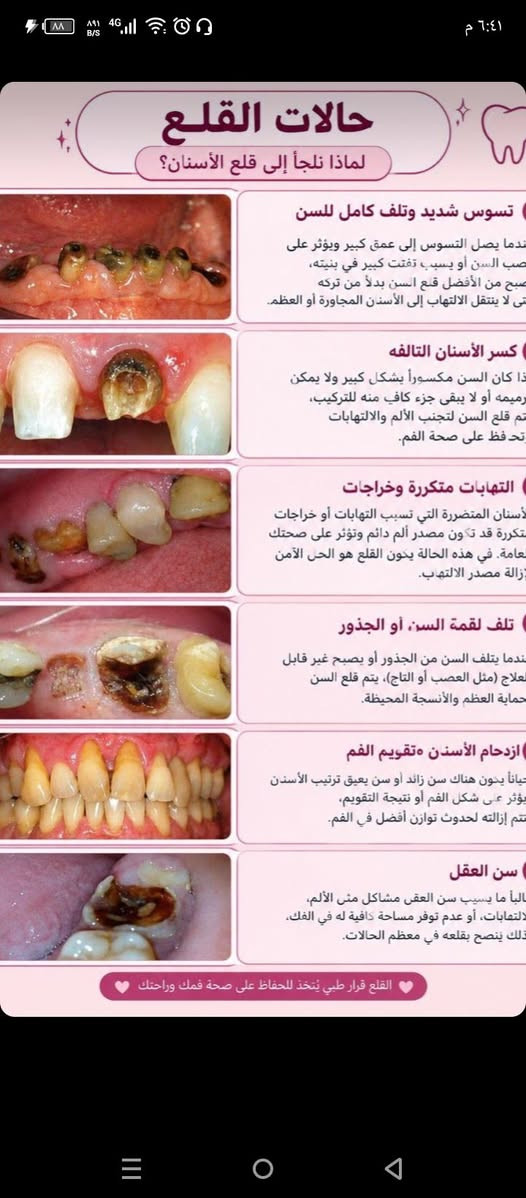 عيادات الجامعة الوطنية • خدمات مجانية • قلع أسنان