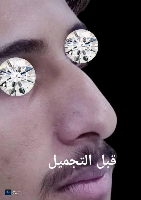 تجميل الانف • طبيعي • قبل وبعد