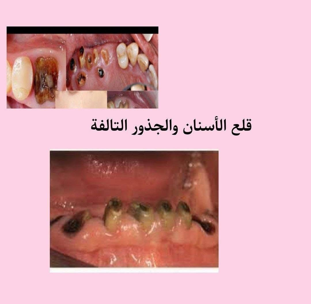 علاج مجاني • جامعة البيان • طب أسنان