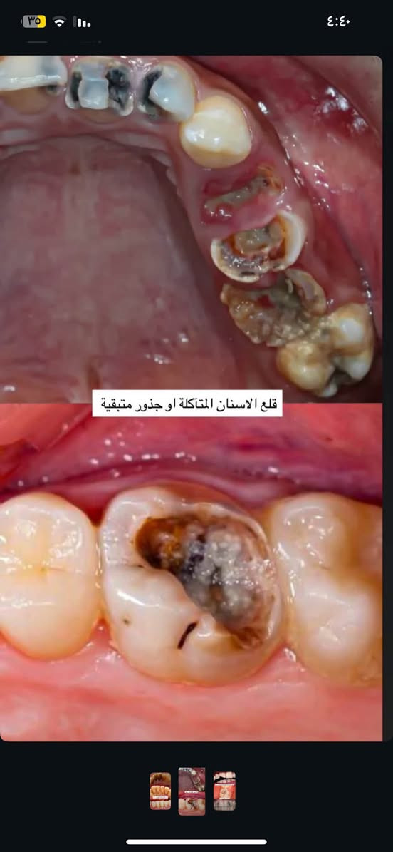 علاج مجاني • تنظيف وإزالة الجير • حشوات تجميلية