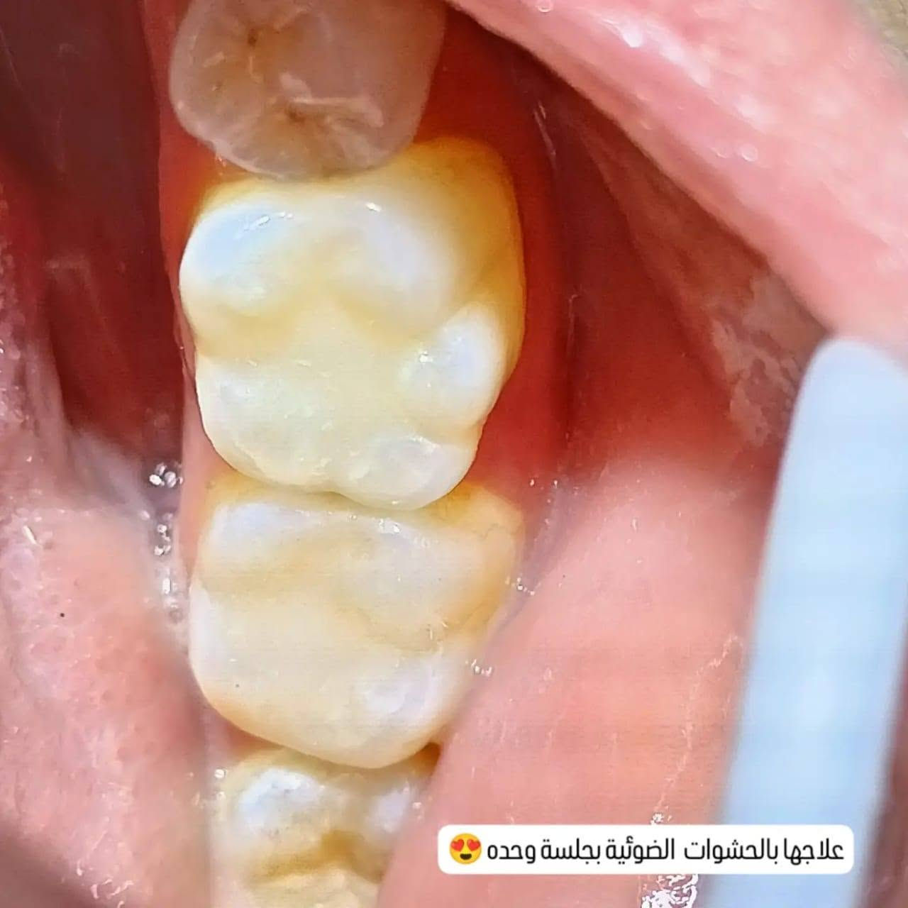 علاج الاسنان بالحشوات الضوئية قبل وصلها للجذر
 ❤️عيادة الابتسامة 🔥💙 
الموقع / بغداد الحسينية ' السوق الاول (الصغير)مقابل دكتورة نجود 
للاتصال /***********

