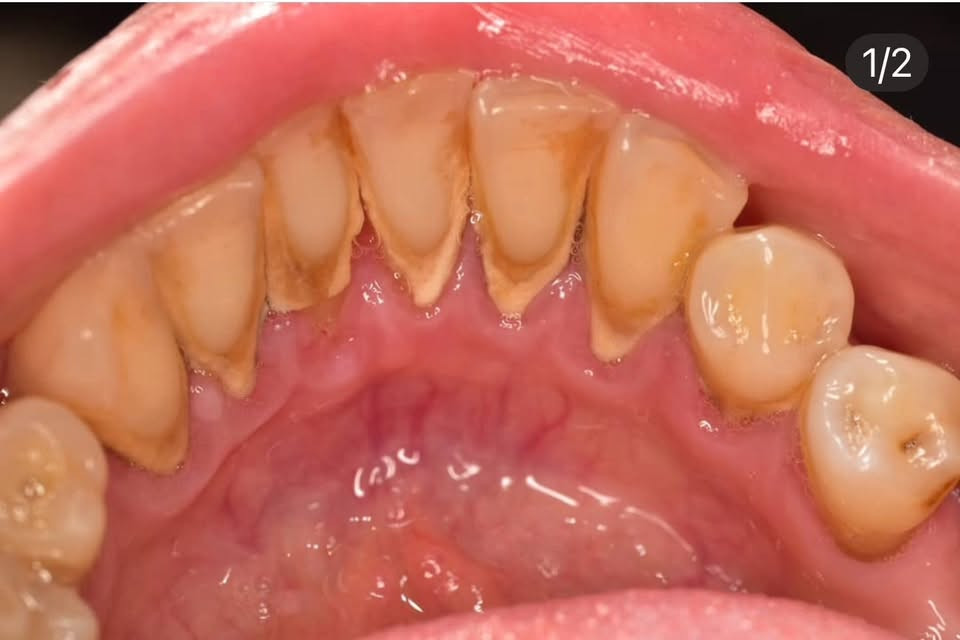متوفر ازالة تكلسات وتنظيف للاسنان للحالات الي بالصورة
علماً ان العلاج مجاني بالكامل
 للاستفسار والتواصل :
***********
