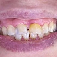 تغليفات الزيركون • ابتسامة طبيعية • الماجدية شارع الملعب