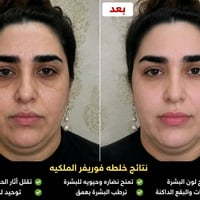 الخلطه الملكيه • تفتيح بشرة • ضمان استرجاع