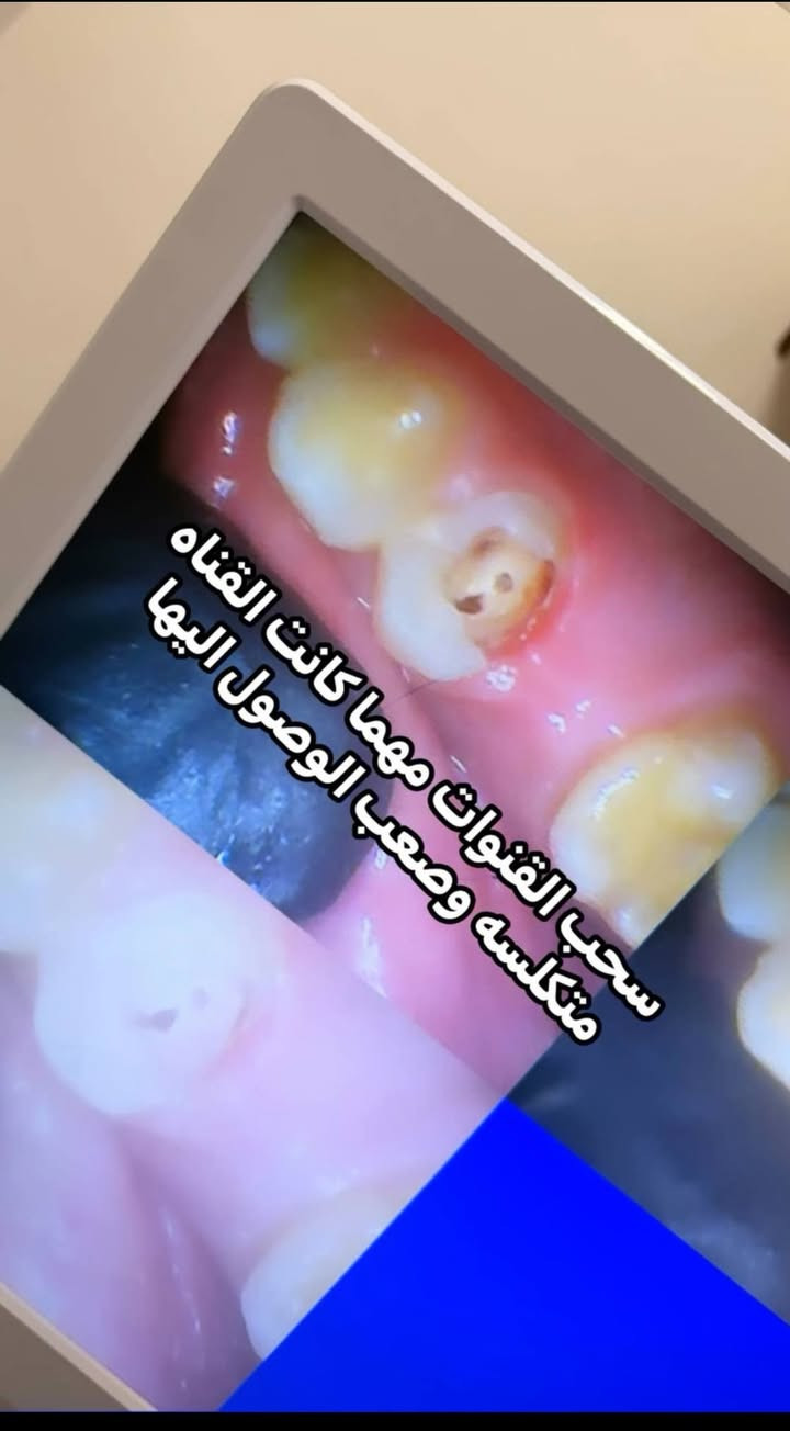 حشوات مجانية • تبييض زووم • بسماية