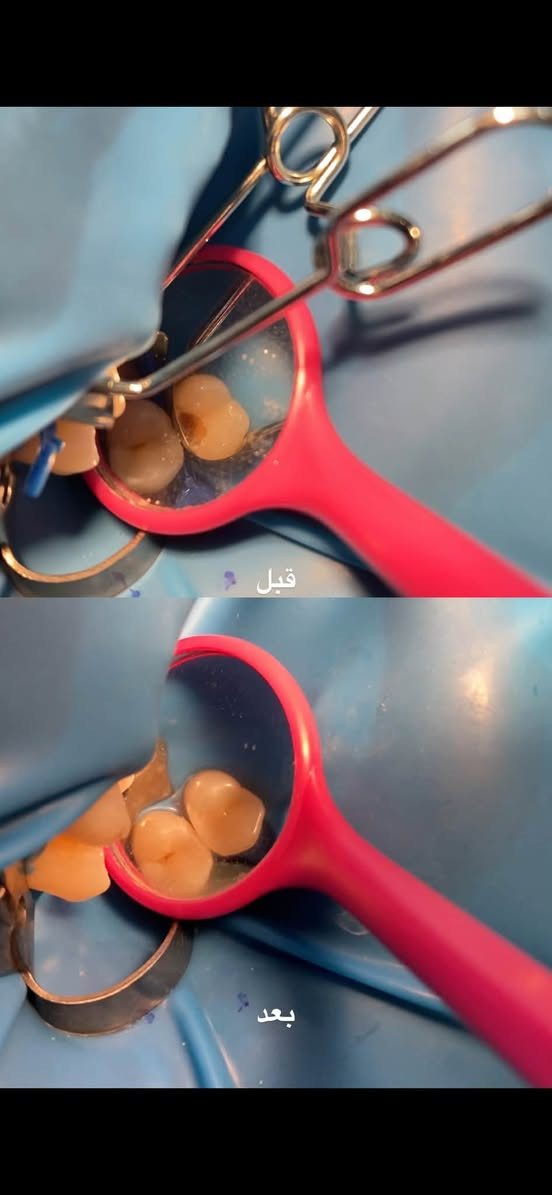 الدكتورة دانية الشمري
📍 كربلاء – عيادات جامعة الزهراوي
✨ العلاج مجاني ✨
الشغل موضح بالصور

📞 للحجز أو الاستفسار واتساب: ***********

عندك تصبغات أو تكلسات بالأسنان؟
احجز جلسة تنظيف حتى ترجع ابتسامتك المشرقة ✨

سن عقل ، سن مكسور، متآكل، أو باقي منه الجذر فقط؟
نقوم بقلع السن بكل راحة وأمان،
وبإشراف جرّاح اختصاص

تعاني من تسوّس؟
عالج السن قبل ما يوصل للجذر
 
اسنان اطفالك محتاجك علاج ؟
احجز موعدك اليوم وخلي ابتسامتك أجمل

