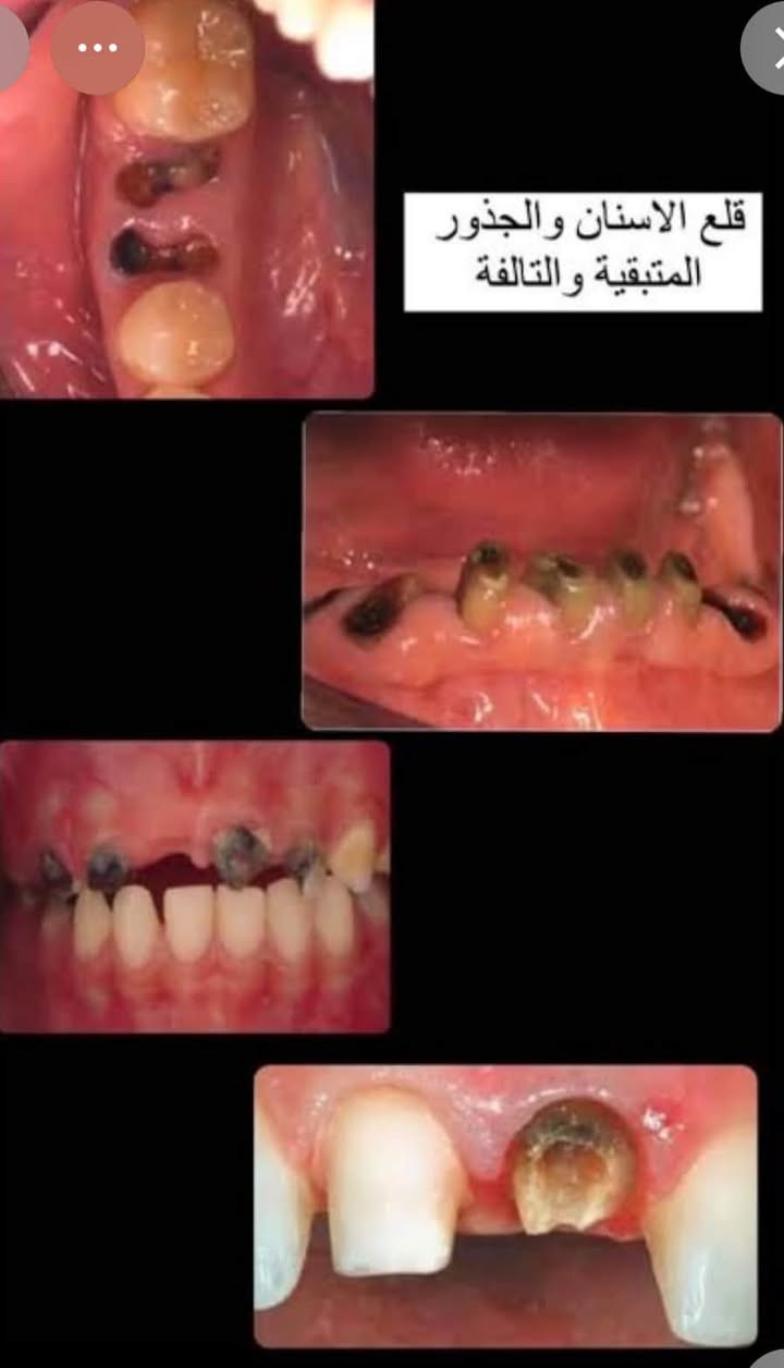 مجاناااااً 
سارعوا بالحجز 
الي عنده اسنان تحتاج قلع او بقايا جذور تالفة 
يتفضل يحجز موعد و ان شاء الله منقصر ويا 
📍الموقع / القادسية - مقابل بانزين خانة البياع - عيادات جامعة ابن سينا
تواصلوا على الرقم / بي واتساب ***********

نص مكتوب في الصور:
- قلع الاسنان والجذور المتبقية والتالفة