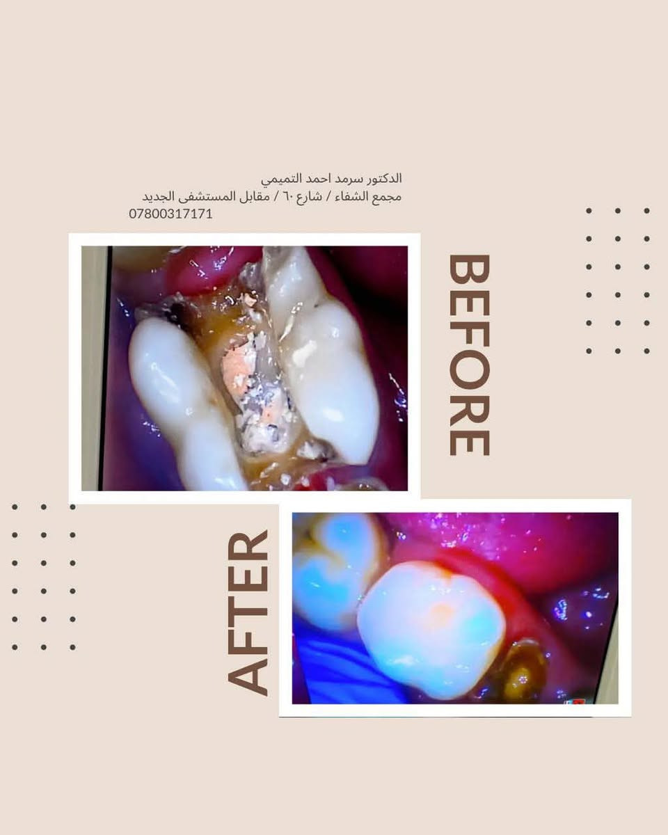 ✨ ابتسامتك تبدأ ويانه! ✨🦷
تعلن عيادة الدكتور سرمد احمد التميمي عن تقديم أفضل الخدمات العلاجية والتجميلية بأحدث الأجهزة حرصًا منا على راحتكم وصحة أسنانكم.

🔹 خدماتنا تشمل:
• تنظيف وتلميع الأسنان
• حشوات تجميلية وعلاج التسوس
• سحب العصب وعلاج الألم
• قلع الأسنان والجراحة
• تركيبات ثابتة ومتحركة
• تبييض الأسنان
• علاج لثة ونزف اللثة
• متابعة وعلاج أسنان الأطفال
وباسعار مناسبة 💙🦷✨

📍 العنوان: [ مجمع الشفاء شارع 60 مقابل المستشفى الجديدة ]
📞 للحجز والاستفسار: [ ***********]

🌟 لأن ابتسامتكم تهمنا… نهتم بأدق التفاصيل لنمنحكم الراحة والثقة.
زورونا وخلي ابتسامتكم تحچي عنكم

