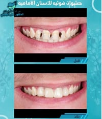 ✌🏻مميزون 😇💪🏻  ✨ حشوات ضوئيه دائميه 🦷 واعاده تفاصيل            الاسنان ...