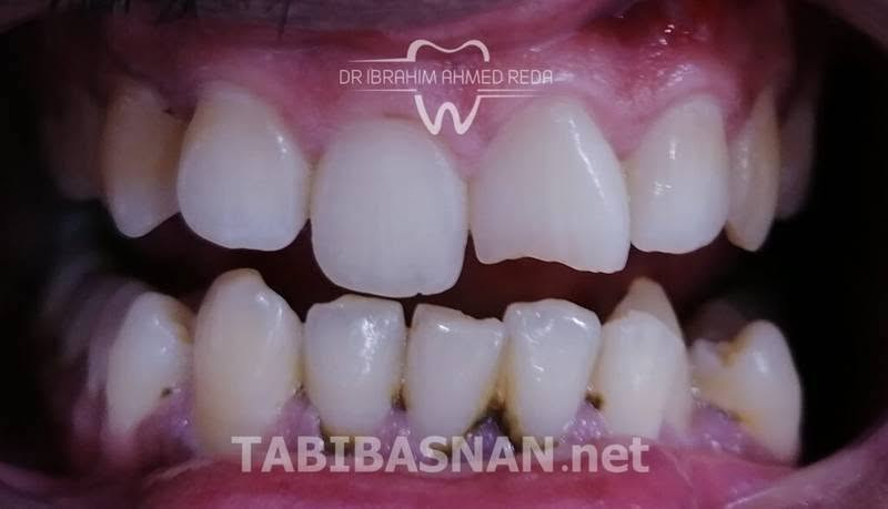 علاج مجاني • حشوة بيضة • البياع