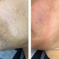 ليزر إزالة شعر • كانديلا GentleMax Pro • النعمانية واسط