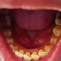 تنضيف اسنان • قلع اسنان • مجانا