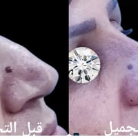 تجميل الانف • طبيعي • قبل وبعد