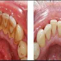 مجاني • تنظيف أسنان • عيادات جامعة الحلة
