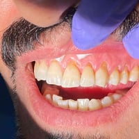 تحسس الاسنان • جذور مكشوفة • حشوات تجميلية