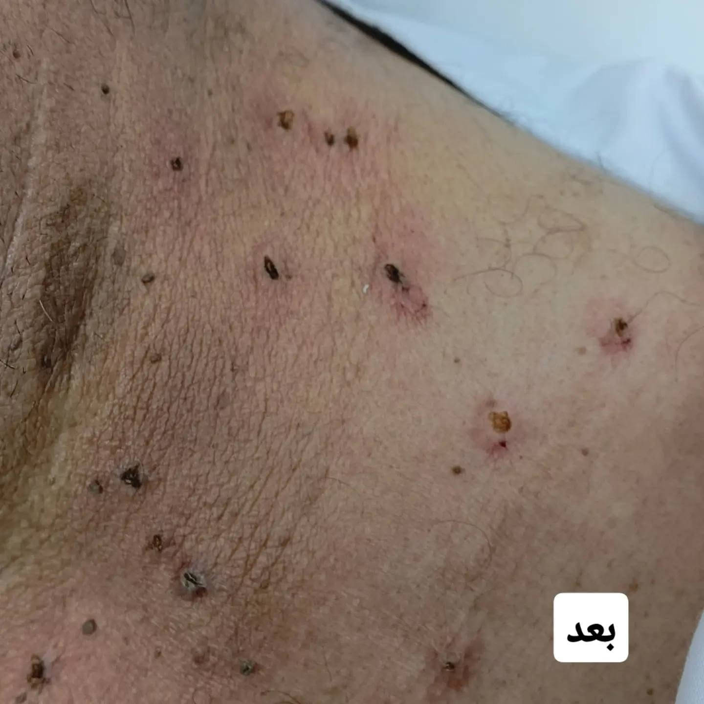 اهلا وسهلا مراجعينا الكرام 
ازالة زوائد جلدية تحت التخدير الموضعي بجهاز الكوي بدون الم ونزف 
للاستفسار ***********
موقع العيادة سوق الشيوخ شارع الاطباء مجاور مختبر الصادق
