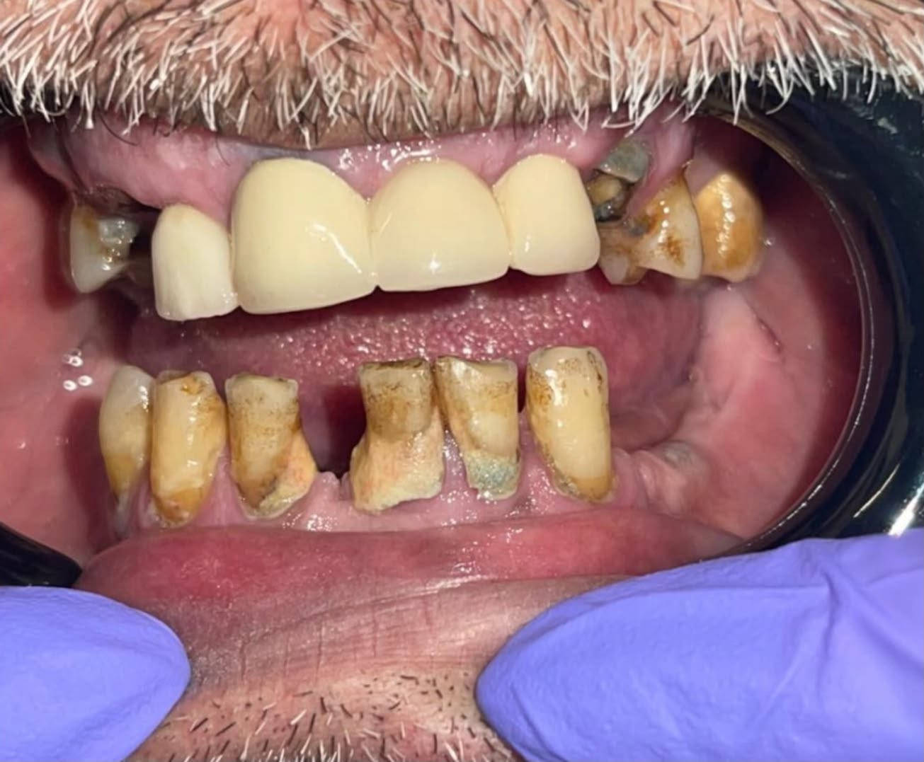 ✨ ابتسامة جديدة… تبدأ بخطة علاج متكاملة ✨
في هذه الحالة تم إجراء:

🦷 تبديل الجسر.
🦷 حشوات بناء.
🦷 علاج جذور (سحب عصب).
🦷 زراعة الأسنان.
🦷 تنظيف شامل وتأهيل كامل للفكين.

✅ تم إنجاز هذا العلاج بالكامل في جلسة واحدة وفق خطة علاجية متكاملة.

🎁 عند علاج عدة أسنان، يحصل المريض على جلسة تنظيف مجانية.

🤍 النتيجة… ابتسامة صحية، طبيعية، وثقة أكبر.
شاهدوا الفرق بين قبل وبعد.

📍 عيادة الدكتورة زينب مازن القيسي
السيدية – شارع الخيزران – مقابل مدرسة الأقصى الأهلية للبنين – بناية أرض بنان الرصاصية.

📞 ***********
