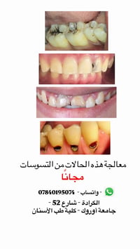 علاج تسوس • مجاني • كلية طب الأسنان
