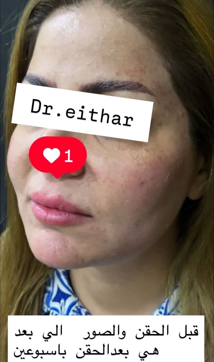 كونتور الوجه  (لفتنك وجنات  واصداغ وتدوير الفك والذقن ونظاره وشفة ونظاره وبوتوكس بعد الحقن باسبوعين ) 🔥🔥🔥

اتمددت عروووض للكادر التدريسي والخريجات والموظفات والعروسات لنهايه الاسبوع ليوم الاربعاء اخر يوم  ثبتتهه الكم بالستوري بالهايلايت وببوست اعلى الصفحة ✨✨

د.ايثار سامي عبد الامير
واسط الكوت الهوره مجمع القبطان طابق اول 

الحجز***********

نص مكتوب في الصور:
- Dr.eithar 1 تجديد لفتنك وجنات واصداغ وتدوير الفك والذقن وشغة ونظاره وبوتوكس
- Dr.eithar
- 1
- تجديد استداره وجه كامله
- وشفه ونظاره وبوتوكس
- Dr.eithar 1 بعد حقن استداره وجه كامله بطريقة كونتور وشد . وشفه ونظاره وبوتوكس بعد االحقن باسبوعين
- Dr.eithar 1 قبل التجديد
- قبل الحقن والصور الي بعد هي بعدالحقن باسبوعين
