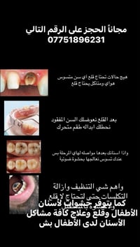 قلع سن • طقم متحرك • حشوة ضوئية