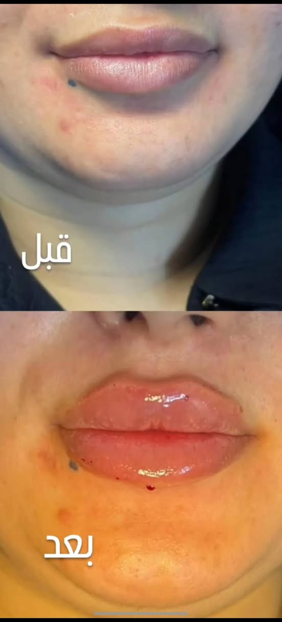خانقين • فلر الشفايف • بوتوكس