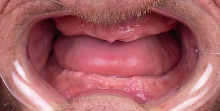 الرمادي • طقم اسنان متحرك • جامعة المعارف