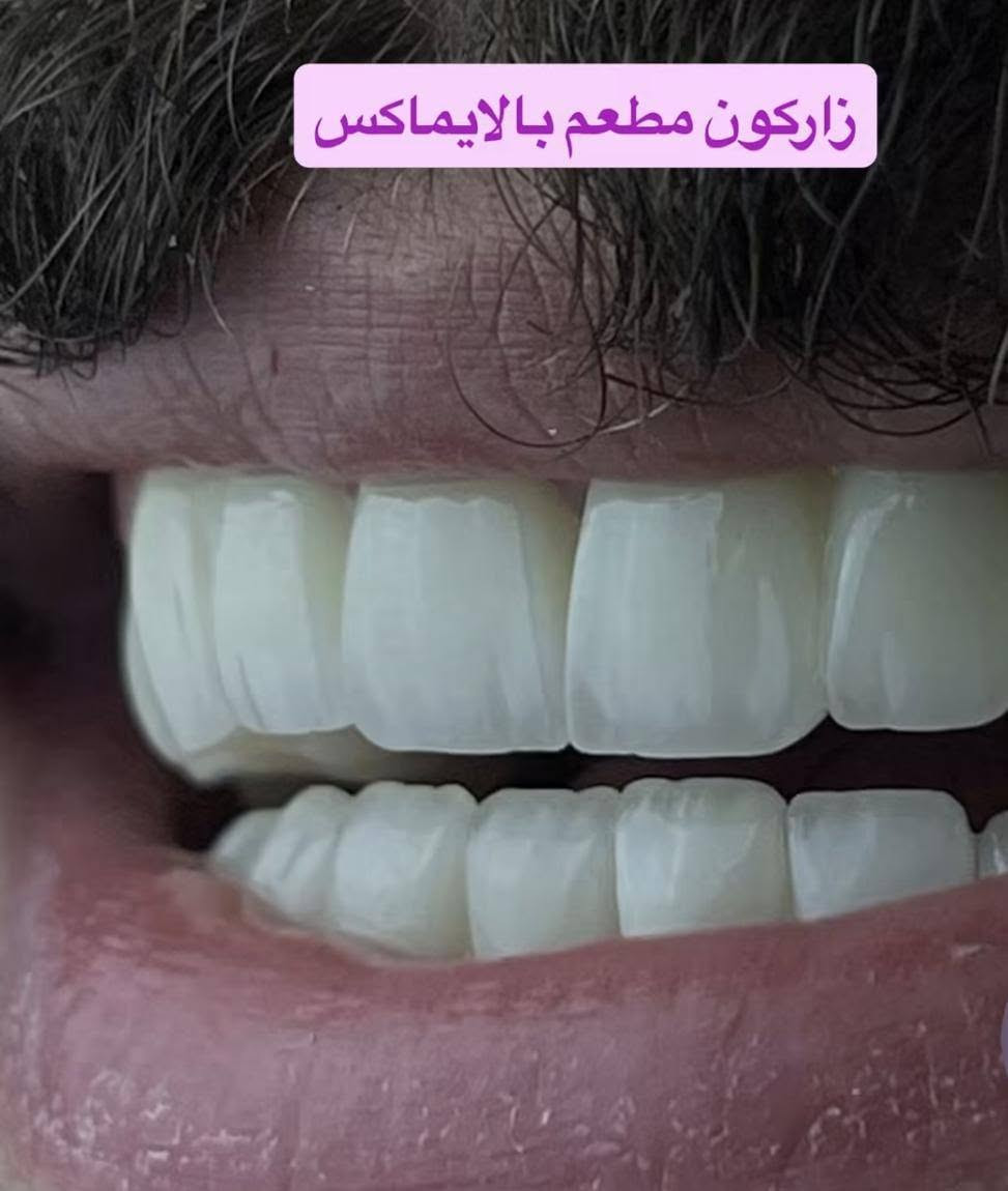 خلي ابتسامتك احلى واجمل مع عيادة ننسوتو😍✨💜
نعالج اسنانكم بجميع انواع الابتسامات :

-الايماكس
-الزاركون المطعم بالايماكس
-الزاركون 7D
-الزاركون الطبيعي

تحت ايادي اطباء مختصين بمجال الابتسامات وبطريقة علمية صحية ..
العنوان :الزعفرانيه اربع شوارع اكبال ابو علي منزليه جنب مركز شاليه للعناية بالسيدات 
يتوفر نظام الاقساط لموضفي ومتقاعدين المصارف (الرشيد ، الرافدين
للاتصال***********او***********

نص مكتوب في الصور:
- E max ایماکس
- زاركون 7D
- زاركون مطعم بالايماكس