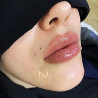 فلر شفة • ١ سيسي • د نور رياض