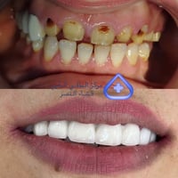 تجميل أسنان • قضاء النصر • قبل وبعد