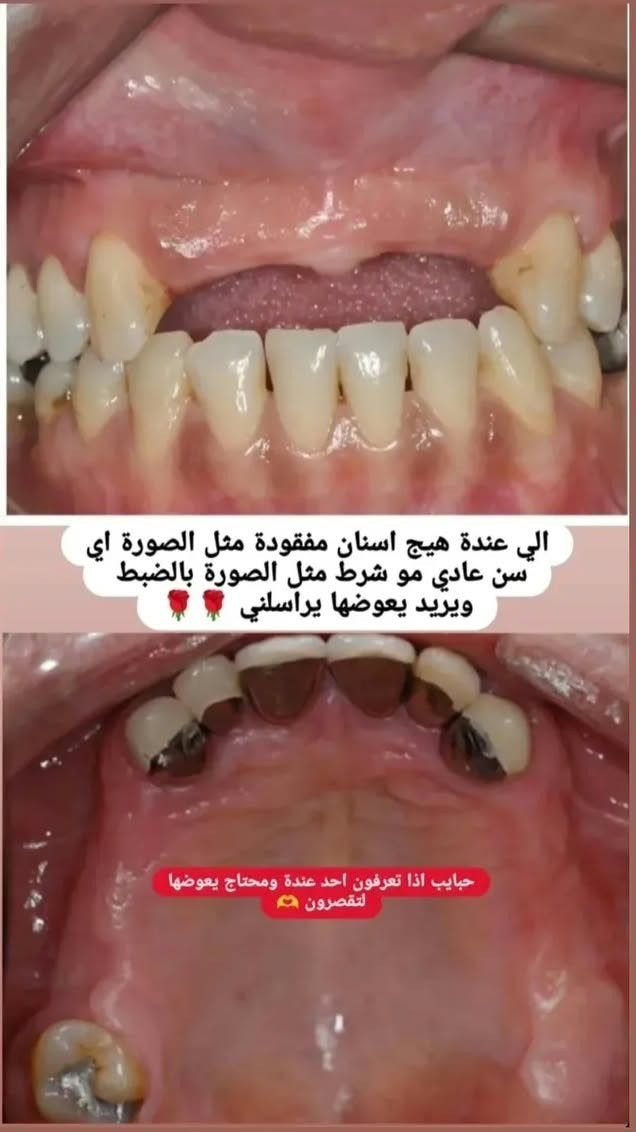 بغداد القاهرة • طقم جزئي متحرك • علاج مجاني