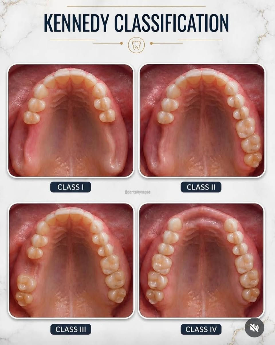 ⚠️اضرار عدم تعويض الأسنان المفقودة بطقم جزئي متحرك ⚠️
🦷 1. تحرك الأسنان المجاورة
عند فقدان سن وعدم تعويضه بطقم جزئي متحرك، تبدأ الأسنان المجاورة بالميلان نحو الفراغ مع مرور الوقت، مما يسبب اضطرابًا في ترتيب الأسنان ويجعل تنظيفها أكثر صعوبة.

🍽️ 2. صعوبة المضغ
غياب الأسنان يقلل من كفاءة المضغ، فيضطر الشخص لاستخدام جهة واحدة فقط، مما قد يسبب إجهادًا للفك ويؤثر في عملية الهضم بسبب عدم مضغ الطعام جيدًا.

🦴 3. تآكل عظم الفك
بعد فقدان السن يبدأ العظم الذي كان يدعمه بالانكماش تدريجيًا نتيجة غياب التحفيز أثناء المضغ، وقد يؤدي ذلك إلى تغير شكل اللثة والفك مع الوقت.

😬 4. اضطراب الإطباق (العضة)
قد يتحرك السن المقابل للفراغ أو زحف الأسنان المجاورة، مما يؤدي إلى خلل في العضة، وقد يسبب صعوبة في إغلاق الفم بشكل طبيعي أو الشعور بعدم الراحة أثناء المضغ.

🗣️ 5. التأثير على النطق والمظهر
فقدان الأسنان، خصوصًا الأمامية، قد يؤثر في نطق بعض الحروف ويغير الابتسامة، مما قد يقلل من ثقة الشخص بنفسه أثناء الحديث أو الابتسام.

⚠️ 6. زيادة الضغط على الأسنان المتبقية
عندما تقل الأسنان التي تتحمل قوة المضغ، يزداد الحمل على الأسنان المتبقية، مما قد يعرضها للتآكل أو الكسر أو مشاكل في اللثة على المدى الطويل.

👩🏻‍⚕️ملاحظة للمتابعين

أنا كطالبة في كلية طب الاسنان - جامعة آوروك الاهلية/ Uruk private university - college of dentistry 
أقدم علاج تعويض الأسنان المفقودة بطقم جزئي متحرك ((مجانًا دون دفع أي مبلغ)) ضمن برنامج التدريب الأكاديمي، بإشراف أطباء اسنان متخصصين، وذلك يشمل:

. جميع حالات الاسنان المفقودة في الصور ادناه👇🏻

الغرض أكاديمي، بشكل مجاني بشرط الالتزام بالتعليمات و بمواعيد الجلسات القادمة.

للاستفسار و الحجز مراسلة من خلال رقم الواتس اب 👇🏻
📞***********
