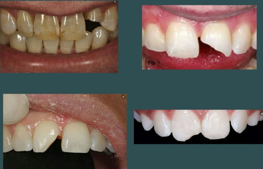 السلام عليكم
🦷🦷متوفر 
⭕️حشوات تجميلية 
 ⭕️تنظيف اسنان 
⭕️قلع الاسنان والجذور المتبقية 
⭕️طقم اسنان جزئي 
❗️العلاج تحت إشراف اطباء اختصاص 
📍العنوان : الدورة / ابو دشير / جامعة كلكامش
 
📞 واتساب :
 ***********
