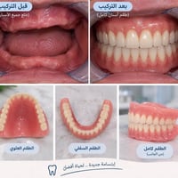 طقم أسنان كامل • مجانا • كبار السن