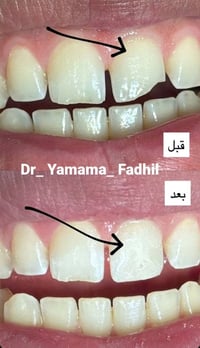 عيادة اليمامة • تجميل أسنان • الخناسة