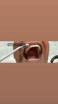 شغل مجاني • طقم اسنان