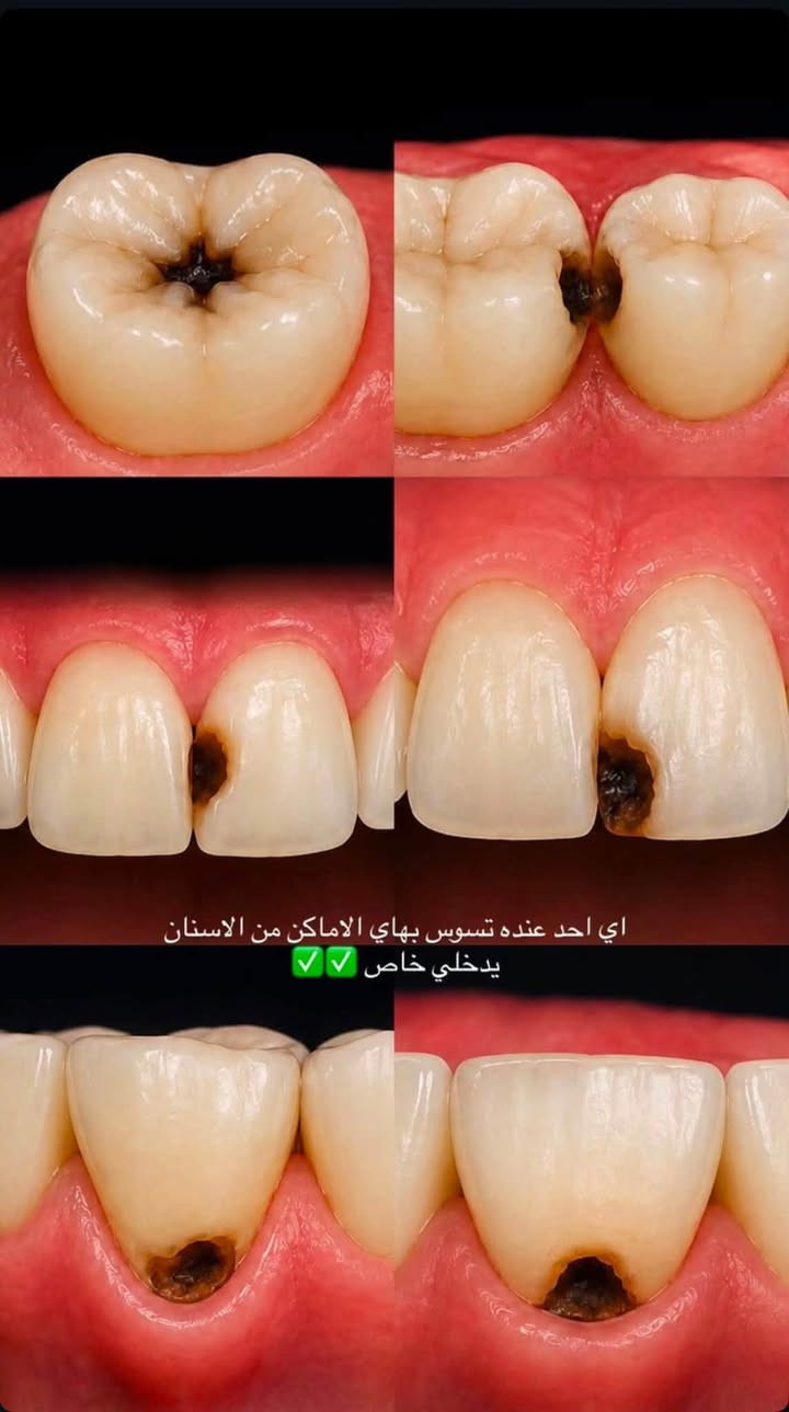 مرحبا
اللي عنده هذه المشاكل باسنانه ومحتاج علاج بأحسن المواد وتحت إشراف دكاترة اختصاص 
يراسلنا ع هذا الرقم 📩*********** 
العنوان :بغداد -طريق المطار -عيادات جامعة المشرق التخصصية .

نص مكتوب في الصور:
- وبالنسبة لتنظيف الاسنان اي احد عنده تكلسات او تصبغات قويه او صفار نتيجة التدخين او الشاي او القهوه او عدم التفريش يدخلي خاص
- اي احد عنده تسوس بهاي الاماكن من الاسنان يدخلي خاص