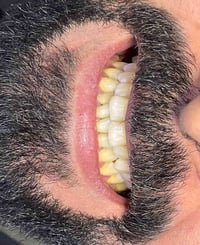 مراجعنا كان فاقد اكثر من سن.وبعد قراءة الأشعة ثلاثيه الأبعاد كانت خطه ...