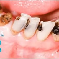 قلع سن • علاج مجاني • عيادات جامعة الرافدين