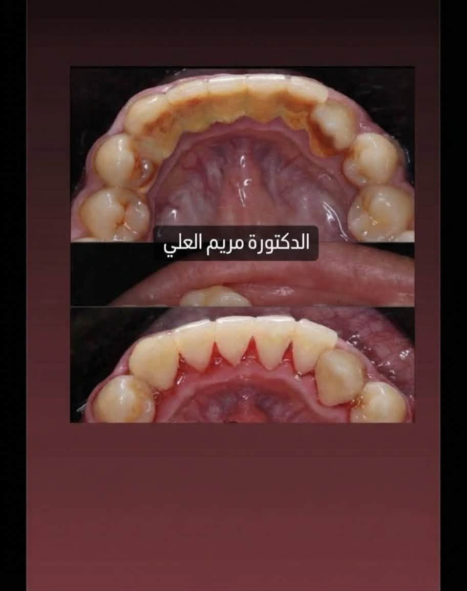 السلام عليكم علاج وتنظيف أسنان (مجاني) *
نستقبل حالاتكم لتقديم خدمات علاجية
متكاملة إشراف وتعقيم تام (بشكل 🦷
مجاني)، وتشمل:
• إزالة الجير والتصبغات وتنظيف اللثة. 🦷
• حشوات الأسنان بمختلف أنواعها. 🦷
• قلع الأسنان بأمان تام.
• علاج مشاكل وآلام مفصل الفك. TMJ

٩ الموقع: كربلاء المقدسة - حي الموظفين
(جامعة كربلاء).
للحجز: ‭***********‬

نص مكتوب في الصور:
- BEFORE TREATMENT
- AFTER TREATMENT
- الدكتورة مريم العلي
