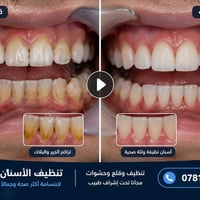 مجاني • تنظيف أسنان • الحلة
