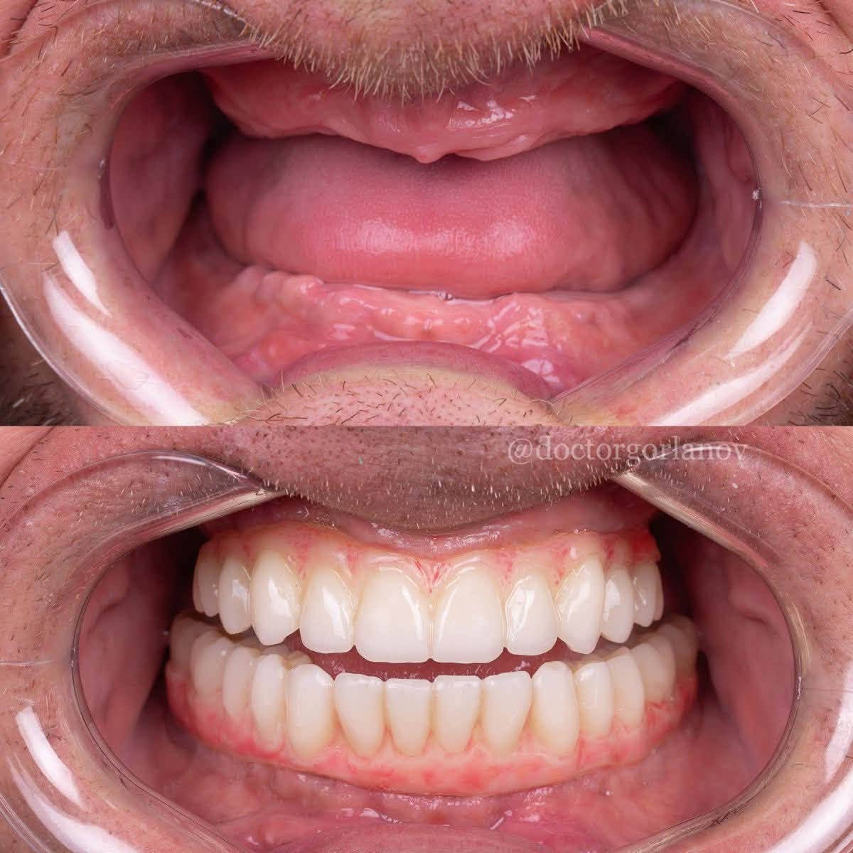 مجانا • حشوات تجميلية • طقم أسنان