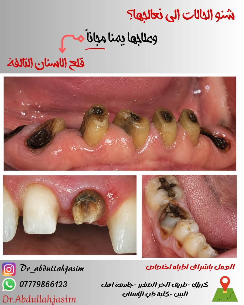 أسنانك توجعك ومأجل العلاج؟🦷✨
لا تخسر سنك ولا تشيل هم التكلفة!
احصل على علاج أسنانك مجاناً 100% وتحت إشراف أطباء
اختصاص:
حشوات ضوئية تجميلية للحفاظ على أسنانك.
• قلع الجذور والأسنان التالفة بدون ألم.
• عمل وتجهيز أطقم الأسنان المتحركة.
• كربلاء - الحر - جامعة أهل البيت / كلية طب الأسنان.
ابتسم بثقة... صحة أسنانك أمانة بيدينا

نص مكتوب في الصور:
- شنو الحالات الى نعالجها؟ وعلاجها يممنا مجاناً تعويض الاسنان المفقوده العمل باشراف اطباء اختصاص Dr_abdullahjasim *********** Dr.Abdullahjasim كربلاء -طريق الحر الصغير- جامعة اهل البيت -كلية طب الاسنان
- شنو الحالات الي نعالجها؟ وعلاجها يمناه مجاناً حشوات ضوئية العمل باشراف اطباء اختصاص كربلاء - طريق الحر الصغير - جامعة اهل البيت -كلية طب الاسنان Dr_abdullahjasim *********** Dr.Abdullahjasim
- شنو الحالات الي نعالجها؟ وعلاجها يمنا مجاناً قلع الاسنان التالفة العمل باشراف اطباء اختصاص كربلاء - طريق الحر الصغير - جامعة اهل البيت - كلية طب الاسنان Dr_abdullahjasim *********** Dr.Abdullahjasim