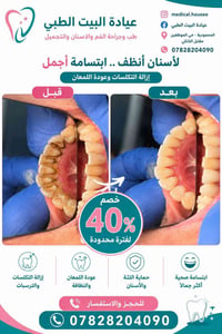 تنظيف الأسنان • إزالة التكلسات • ٤٠٪