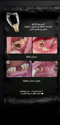 قلع أسنان • مجاني • جامعة كربلاء