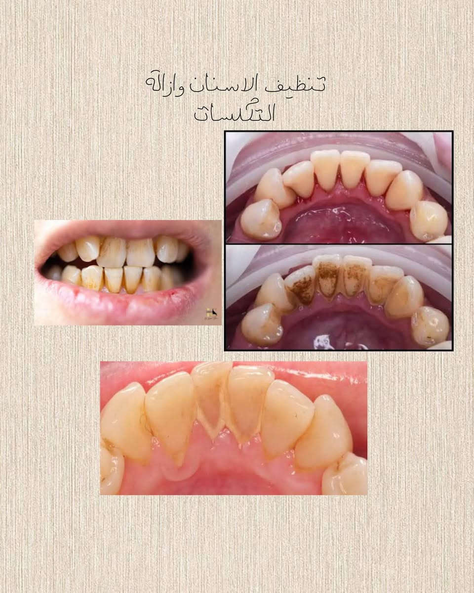 بغداد السيدية • علاج مجاني • تنظيف الاسنان