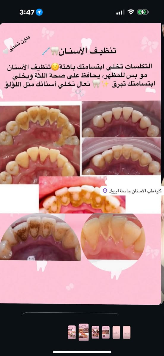 علاج جميع مشاكل الاسنان مجاناً
حشوات تجميليه /تنظيف/قلع الجذور التالفه/ تعويض الاسنان المفقوده/علاج اسنان الاطفال /تقويم 

📍📍بغداد الكراده  ٥٢ جامعة أوروك طب الأسنان مقابل مطعم نانار 

لتواصل خاص او واتساب +9647888597722

نص مكتوب في الصور:
- حشوات الأسنان تسوس بسيط اليوم.. ممكن يصير وجع بكرة تعالو نعالج التسوس وخلي ابتسامتك صحية كلية طب الاسنان جامعة اوروك
- بدون تخدير تنظيف الأسنان التكلسات تخلي ابتسامتك باهتة تنظيف الأسنان مو بس للمظهر، يحافظ على صحة اللثة ويخلي ابتسامتك تبرق تعال نخلي أسنانك مثل اللؤلؤ كلية طب الاسنان جامعة اوروك
- قلع الاسنان الجذور والأسنان التالفة تأخذ راحتها وتسبب ألم ومشاكل 😣 خلي ابتسامتك مرتاحة - قلع بسيط ونرجع راحتك 🦷🤍✨