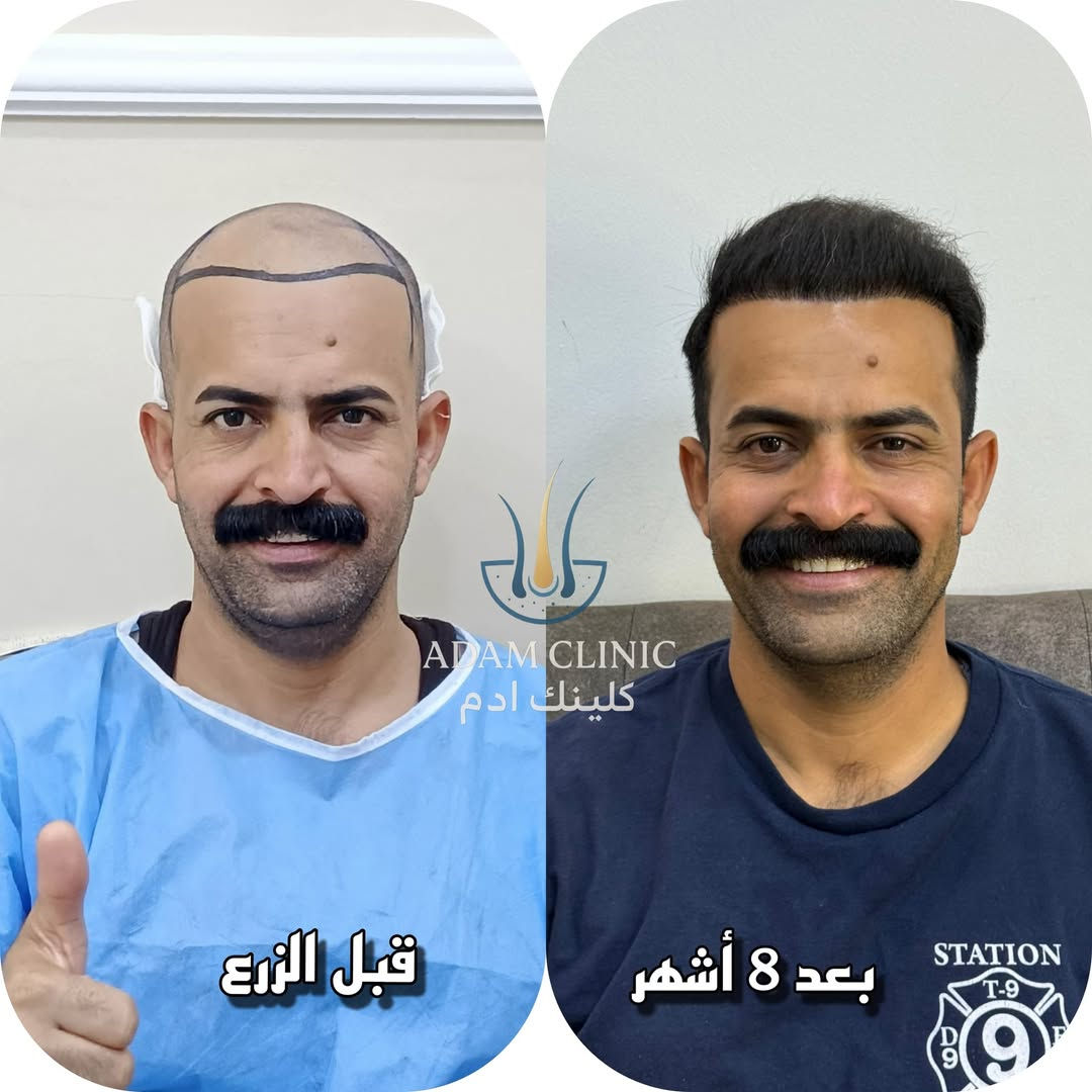 ٨ أشهر • زرع شعر • ادم كلينك