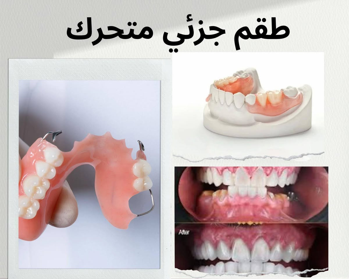 معالجة مجانية ❗❗
.................

-حشوات ضوئية

-قلع الأسنان و الجذور التالفة

-ازالة التكلسات و تنظيف الأسنان

-تعويض الأسنان المفقودة جزئيًا

تحت إشراف أطباء اختصاص
..............
📍 بغداد شارع المطار_عيادات جامعة البيان
📱 للتواصل ***********

نص مكتوب في الصور:
- الدكتورة لجين سعد الجلبي Dr. Loujain saad AL-chalabi
- معالجة مجانية *********** شارع مطار بغداد_عيادات جامعة البيان Instagram scan me lloujain.s حشوات ضوئية قلع الأسنان و الجذور التالفة ازالة التكلسات و تنظيف الأسنان تعويض الأسنان المفقودة جزئياً تحت إشراف أطباء اختصاص
- طقم جزئي متحرك
- 1-مُعالجة تسوس الاسنان بأستخدام حشوات ضوئيه ومعدنيه
- ٢- تنظيف الاسنان وازاله التكلسات والتصبغات.